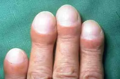 Clubbing of the fingers in Idiopathic Pulmonary Fibrosis (IPF)