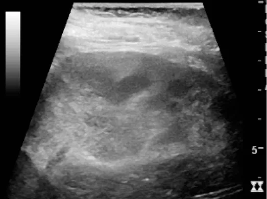 Acute pyelonephritis with increased cortical echogenicity and blurred delineation of the upper pole. For context, see en:Renal ultrasonography