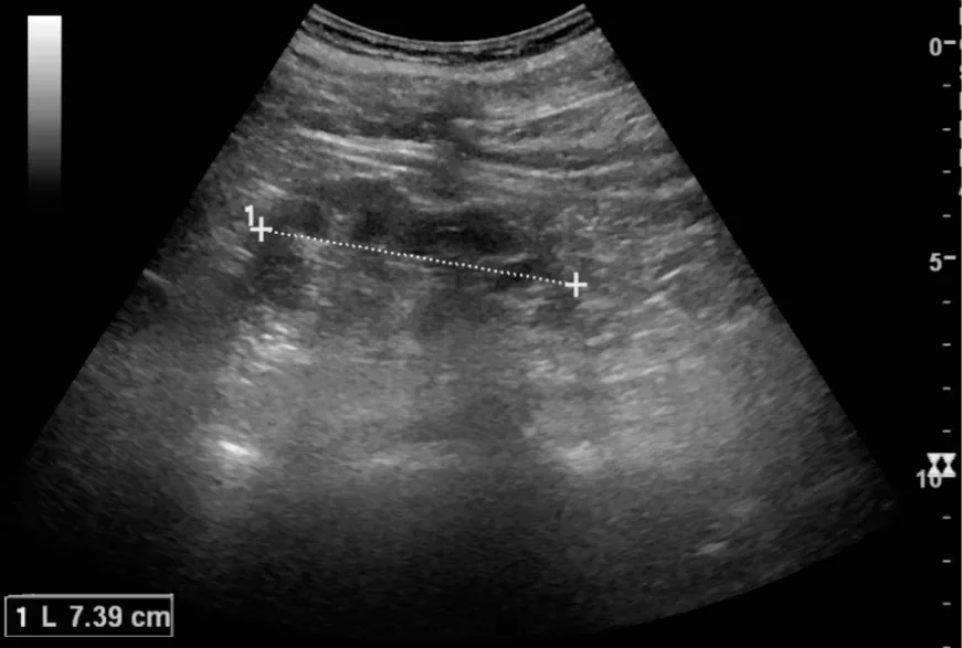 Chronic pyelonephritis with reduced kidney size and focal cortical thinning. Measurement of kidney length on the US image is illustrated by ‘+’ and a dashed line. For context, see en:Renal ultrasonography