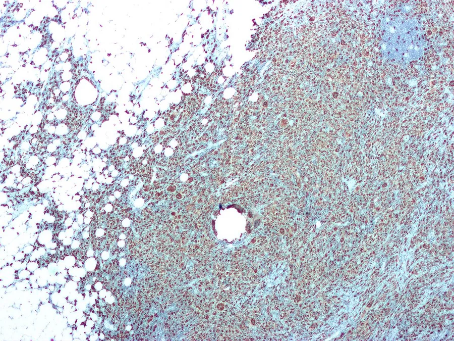 CD68 immunohistochemical staining of macrophages and giant cells in a case of xanthogranulomatous pyelonephritis. In this case, CT findings had suggested the possibility of renal cell carcinoma, thus it was excised.