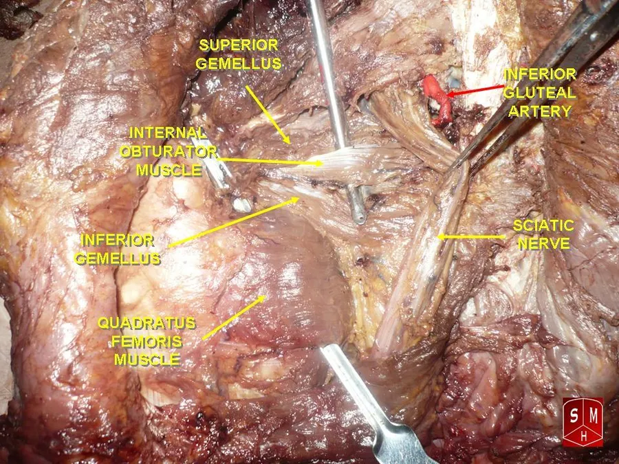 Quadratus femoris muscle