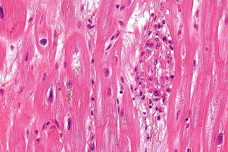 Very high magnification micrograph of rheumatic heart disease. H&E stain. It is due to Streptococcus pyogenes. Microscopic findings include Anitschkow cells (also known as caterpillar cells), and Aschoff bodies. Anit