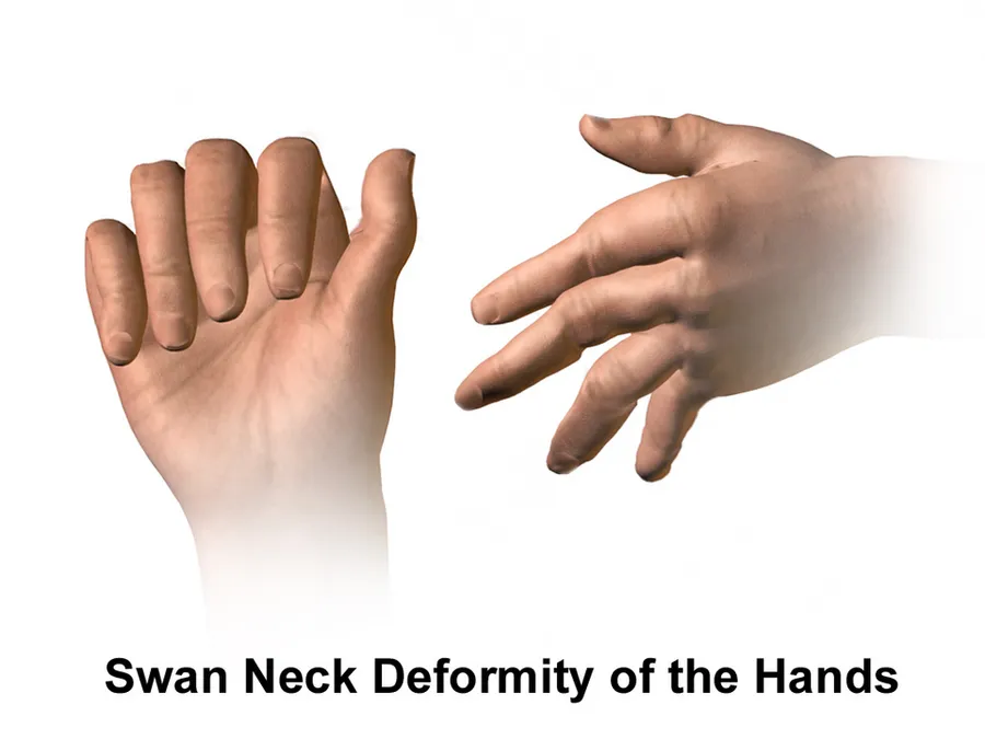 An illustration depicting rheumatoid arthritis and the swan neck deformity.