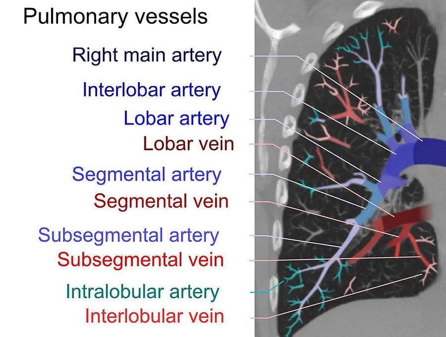 Artificially colored high resolution computed tomography of a normal lung, using a 1 cm thick maximum intensity projection in order to visualize the different levels of pulmonary arteries and veins.