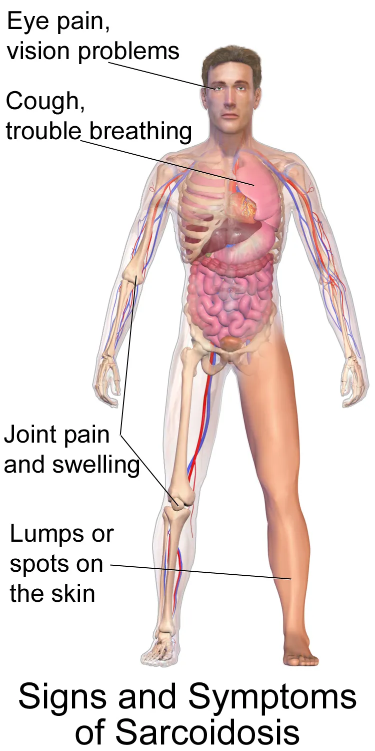 An illustration depicting sarcoidosis.