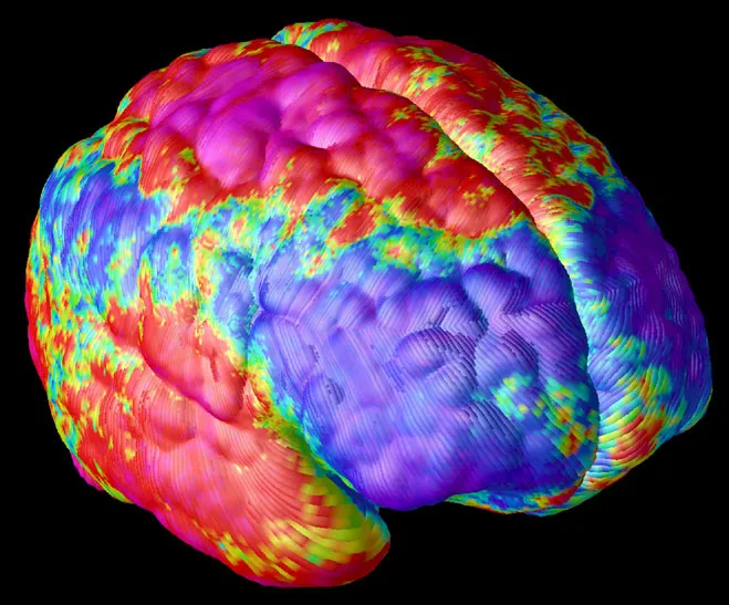 Image of a schizophrenic brain where the lighter the color the more deficiencies in neuronal tissue of the cortex.