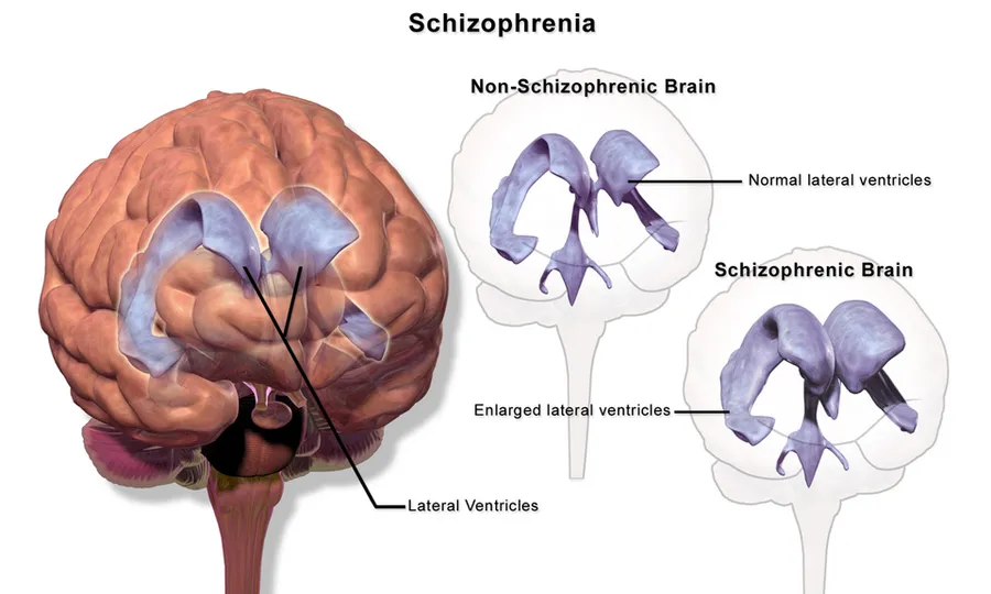 Lobes that schizophrenia effects.[1]