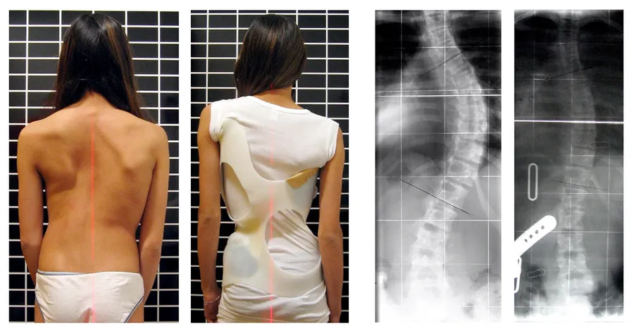 Scoliosis patient in Chêneau brace correcting from 56° to 27° Cobb (primary correction of 52%).