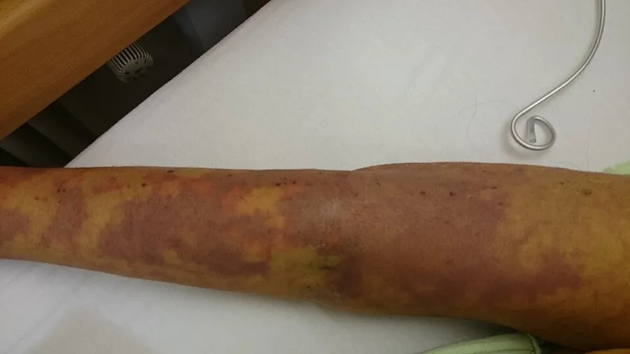 Patient with severe septic shock & ischemia zones on the skin in microthrombs.