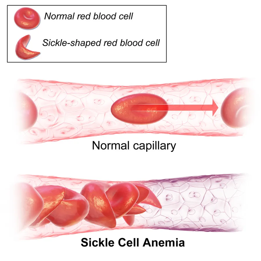 Sickle Cell Anemia.