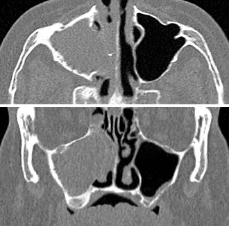 Axial plane (top) and coronal plane (bottom) CT scans of chronic sinusitis. History: A 58 year old man with 3 weeks of symptoms including pain over the sinuses, fever and tachycardia. Findings: The right maxillary sinus