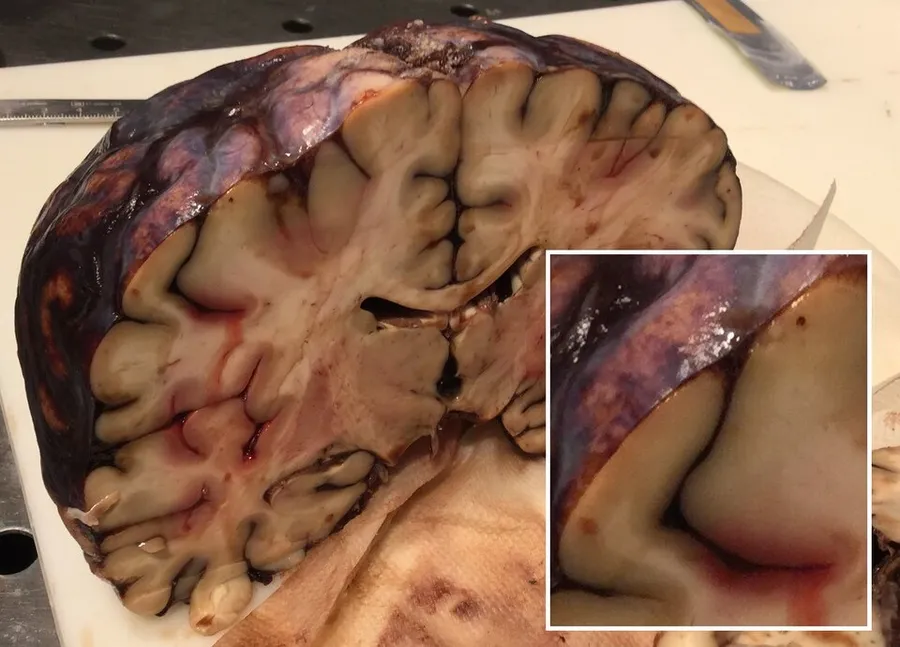 Gross pathology of an autopsy case with fatal acute subarachnoid hemorrhage, cut with a coronal section. The arachnoid mater is left in place on the exterior surface, containing extensive hemorrhage that also fills the s