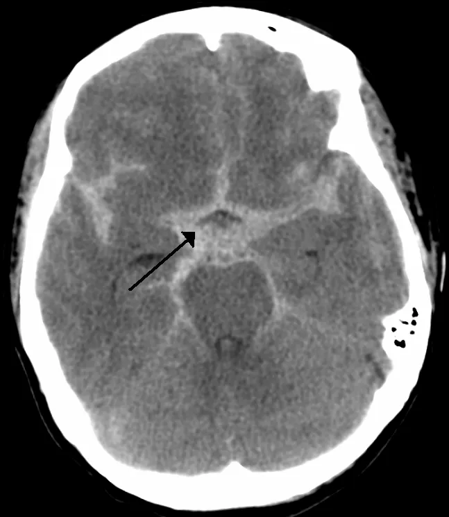 A subarachnoid hemorrhage.