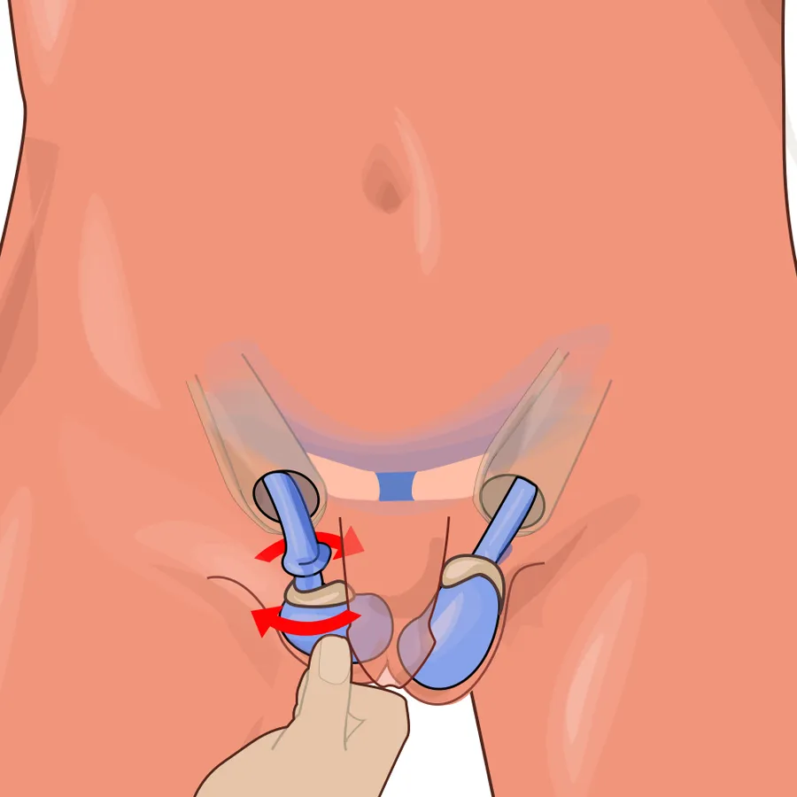 Testicular torsion