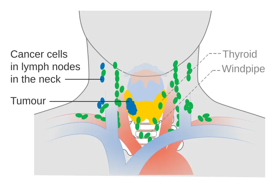 Diagram showing stage N1b thyroid cancer.