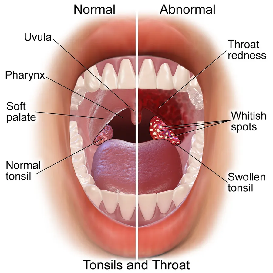 Tonsillitis.