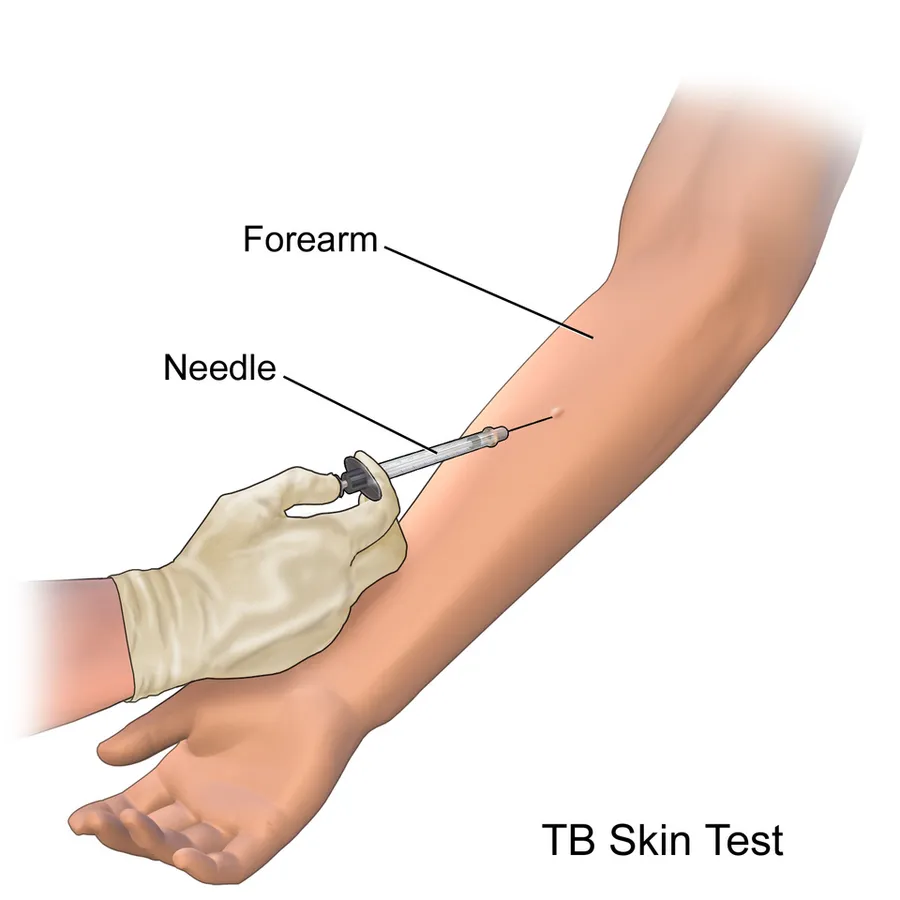 A medical illustration depicting a tuberculin skin test.