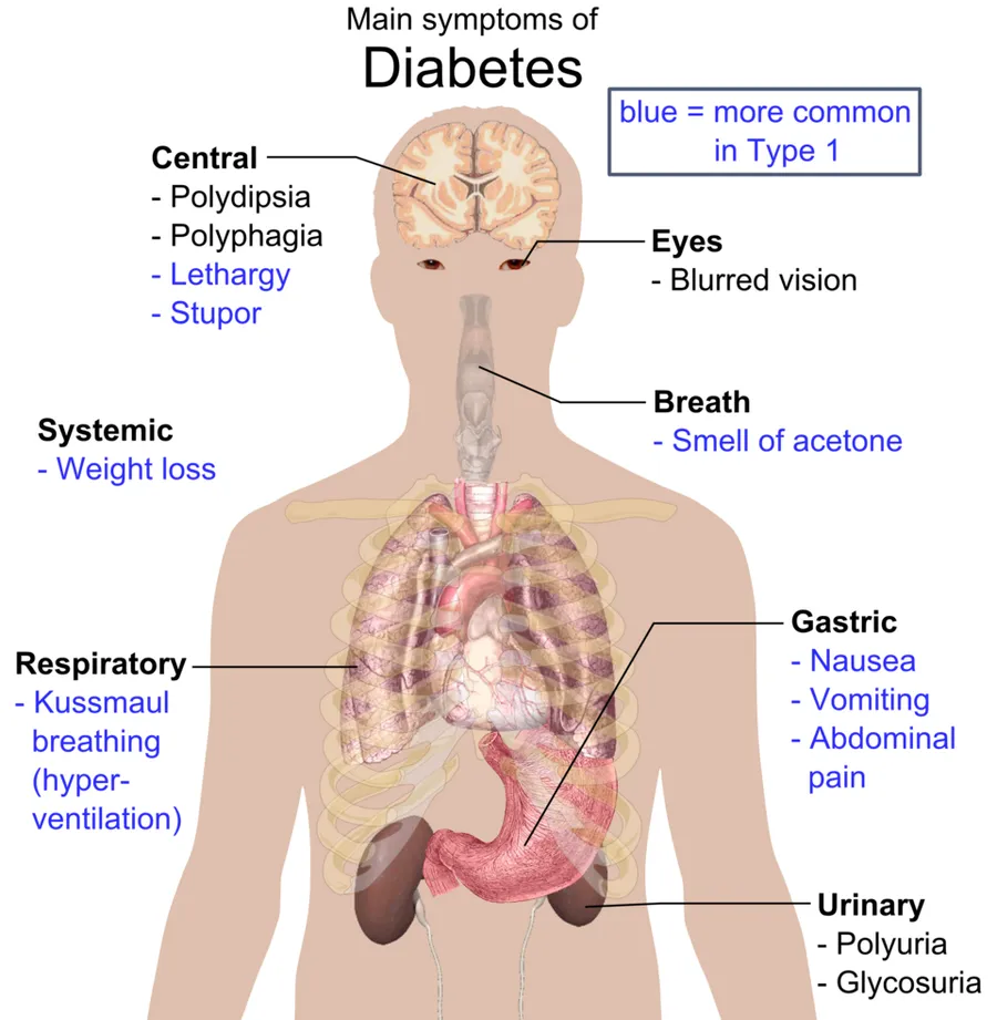 Overview of the most significant possible symptoms of diabetes. See Wikipedia:Diabetes#Signs_and_symptoms for references. To discuss image, please see Template talk:Human body diagrams