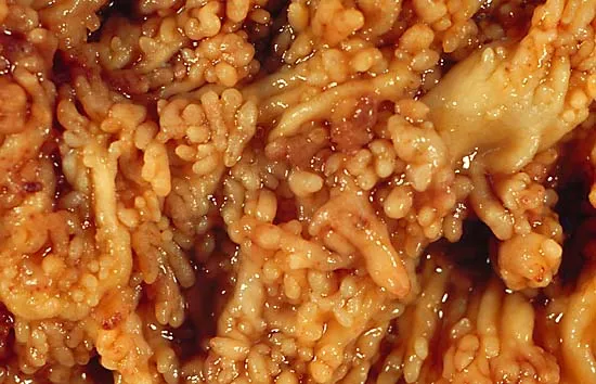 Chronic Ulcerative Colitis These photos are from a total colectomy done for clinically severe, intractable chronic ulcerative colitis (CUC). The photo above shows a veritable shag carpet of inflammatory pseudopolyps. Yes