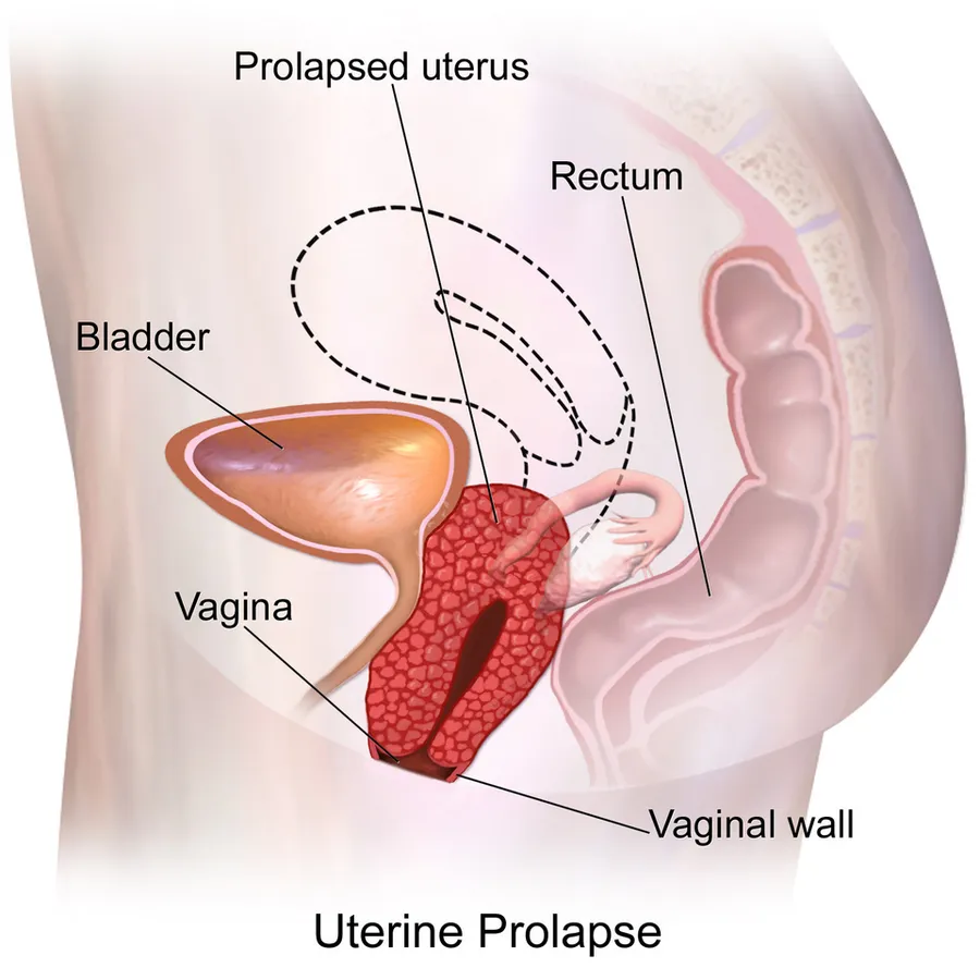A medical illustration depicting a uterine prolapse.