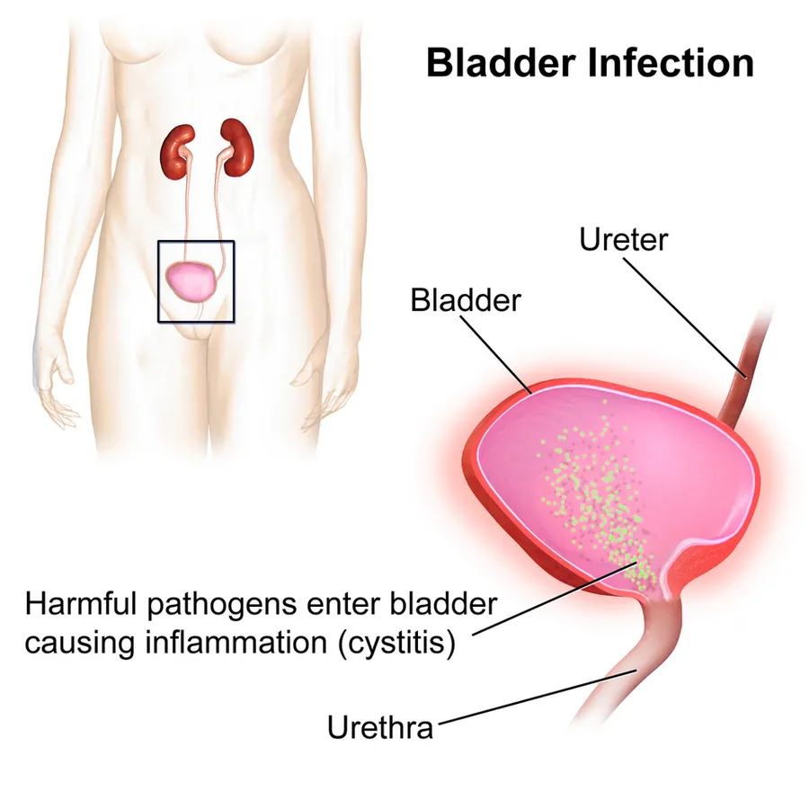 Bladder Infection.