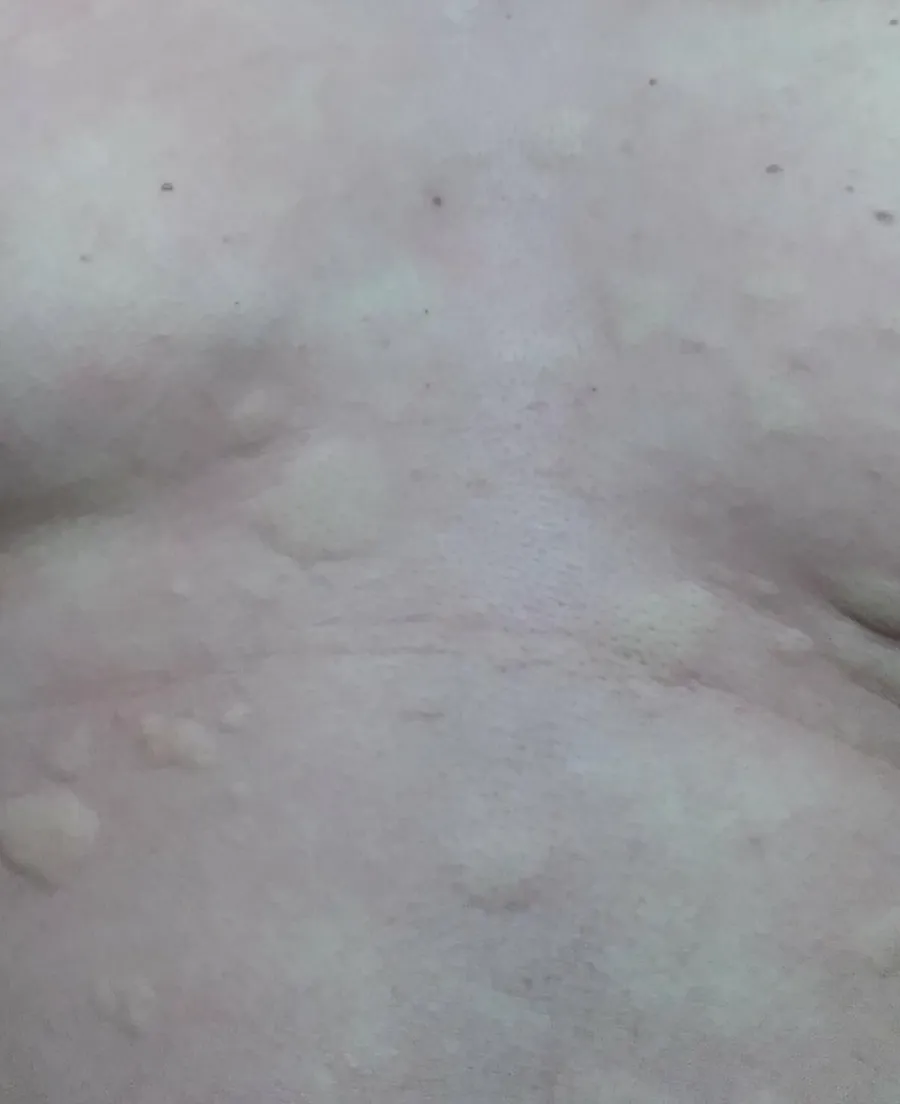 Hives