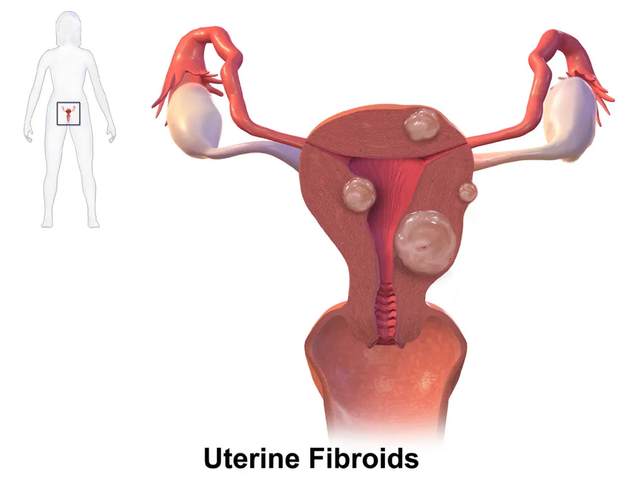 A medical illustration depicting uterine fibroids.