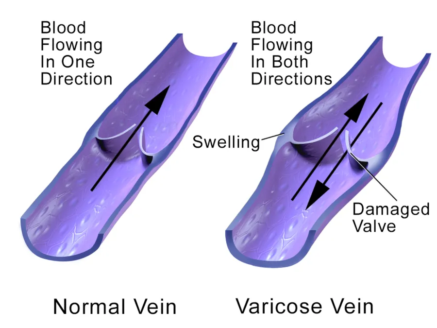 Varicose Veins.