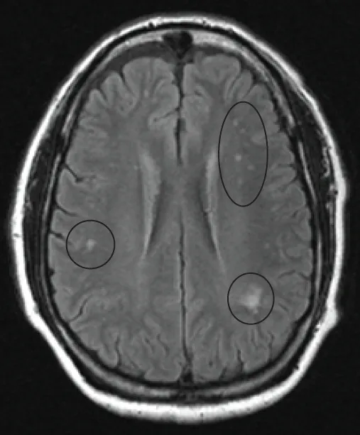 MRI image of the brain in an axial view showing the “precontrast FLAIR image”. Note the abnormal lesions (circled) in the per ventricular area suggesting white matter pathology in someone with vitamin B12 deficiency.